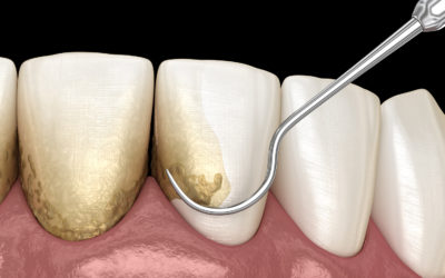 Periodontal Disease