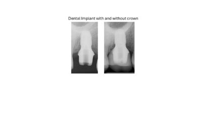 Dental Implants