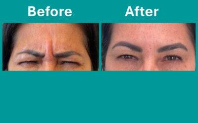 Now Available: Botulinum Toxin Therapy and Dermal Fillers